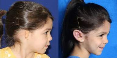 Ear implant before and after photo